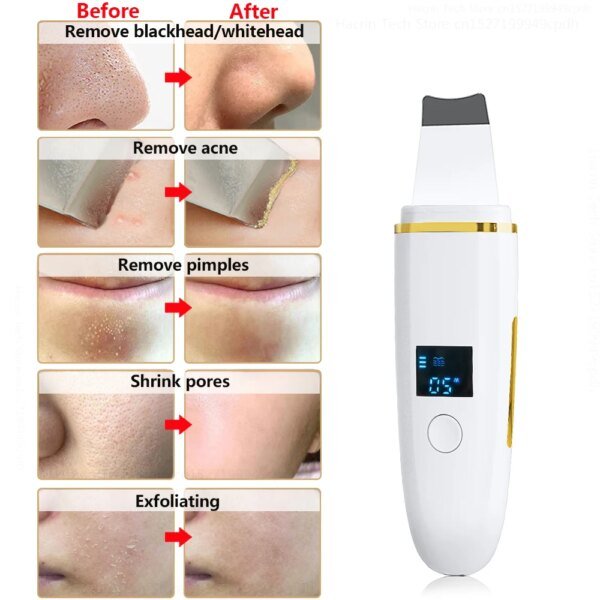 Limpiador ultrasónico de piel, removedor de puntos negros, exfoliante ultrasónico, pala facial, lifting facial, elimina poros, acné, limpieza profunda - Image 5