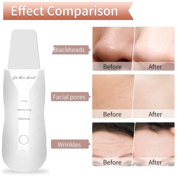 Depurador eléctrico de piel, removedor de puntos negros, limpieza facial profunda, lifting, limpiador de poros iónico para acné, espátula facial, pala limpiadora - Image 3